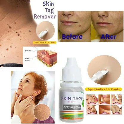 SKIN TAG GOTA REMOVEDOR DE VERRUGAS Y LUNARES