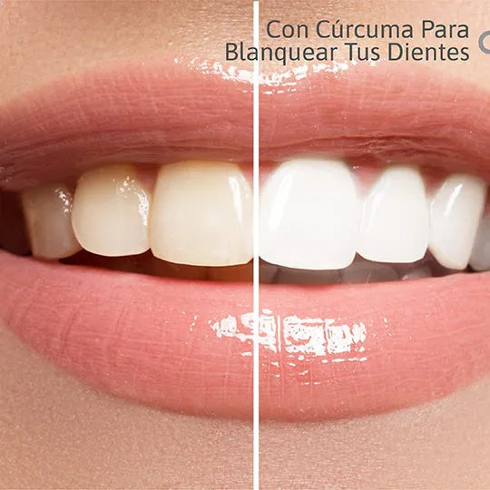 CARBON WHITE: Blanqueador Dental Avanzado